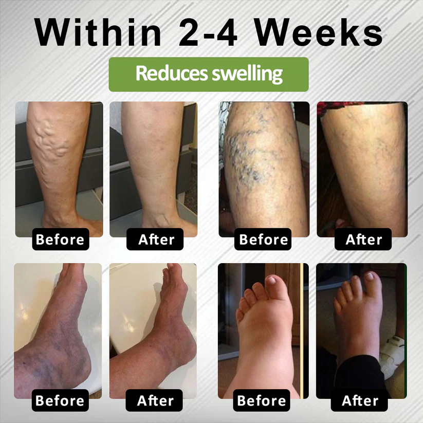 NovaRX® Edema Drain Duo Therapy Roller Cream