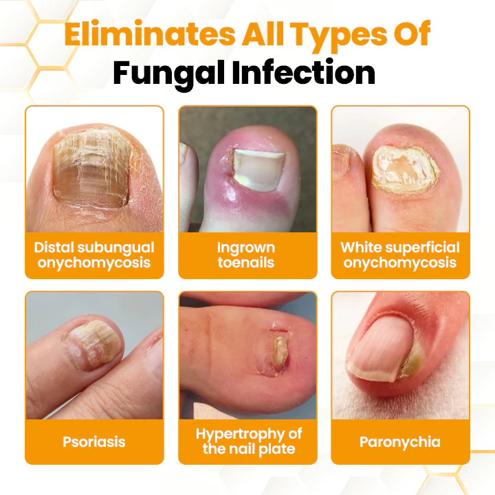 Fivfivgo™ BeeVenom Anti-Fungal Nail Renewal Oil