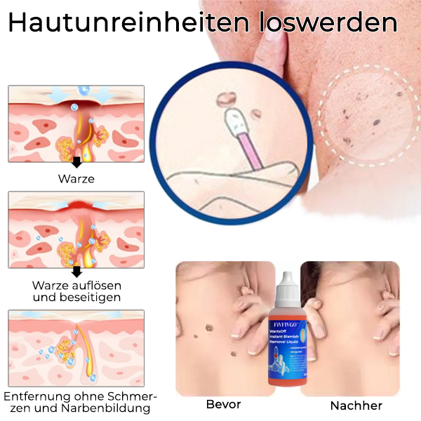 Fivfivgo™ WarzenOff Sofortige Entfernung von Hautunreinheiten