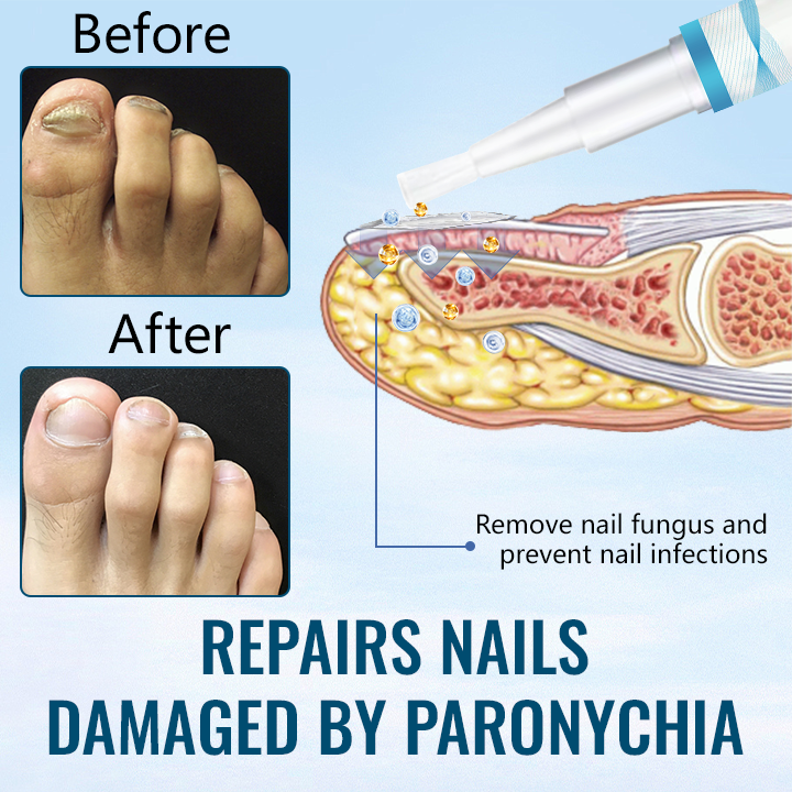 Fivfivgo™ Anti-Paronychia Nail Repairing Gel