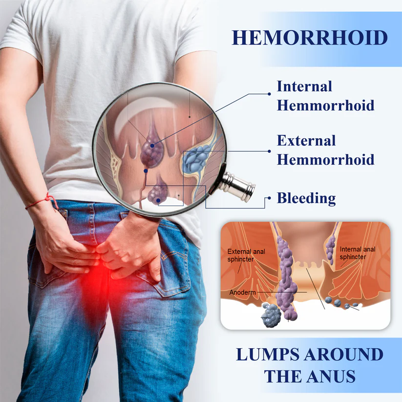 Fivfivgo® Medical Hemorrhoid Herbal Gel with Applicator