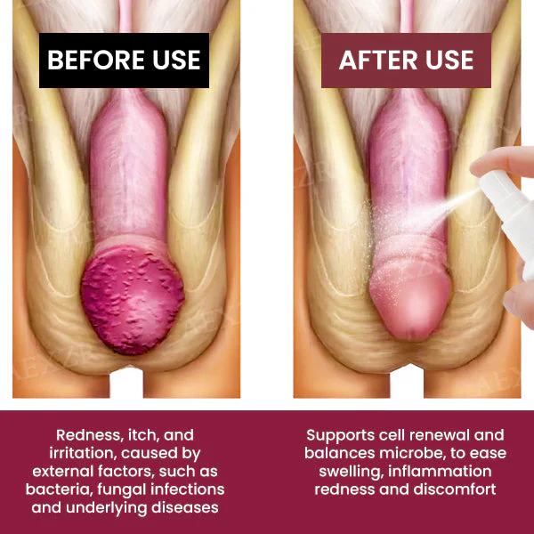 Fivfivgo® Balanitis Treatment Spray
