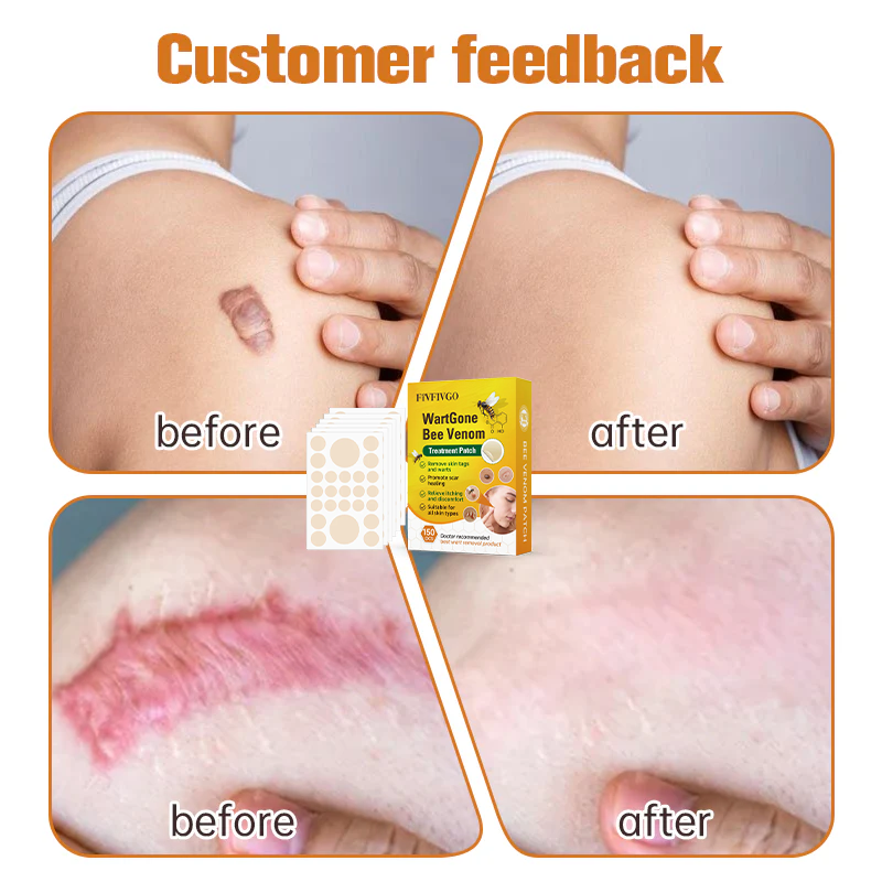 Fivfivgo™ WartGone Bienengift-Behandlung Patch