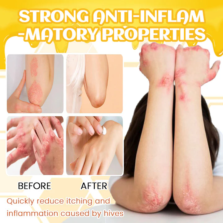 Fivfivgo™ PsoriX Bienengift-Creme