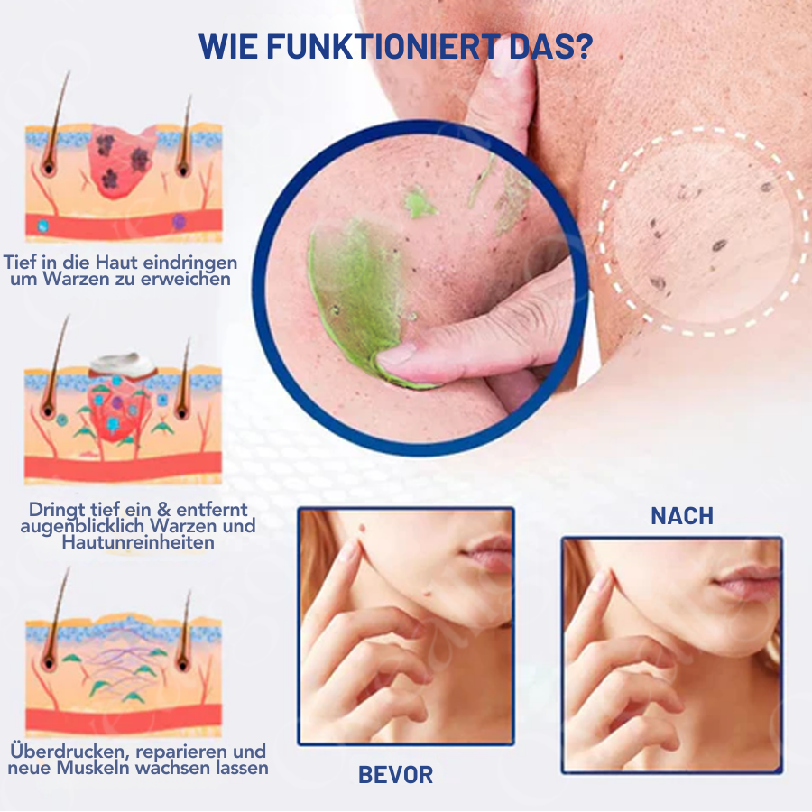 ✅ Offizieller Laden: Fivfivgo™ NatureErase Sofortige Maulwurf- und Fleckencreme