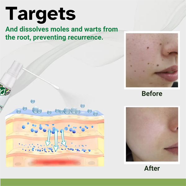 Fivfivgo™ Herbal Moles & Warts Removal Spray