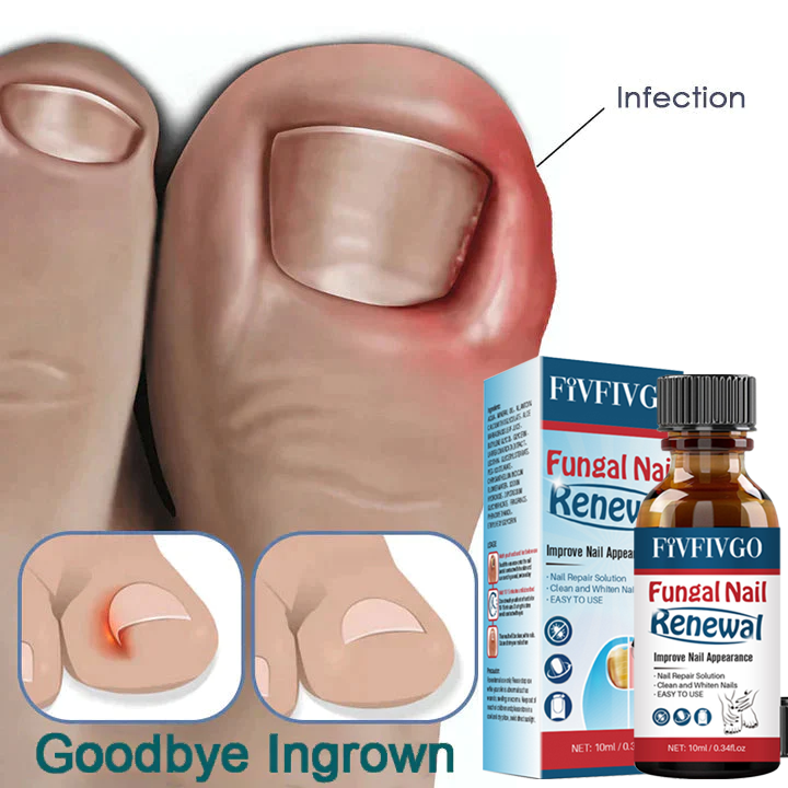 Fivfivgo™ Gel zur Behandlung von Nagelpilz