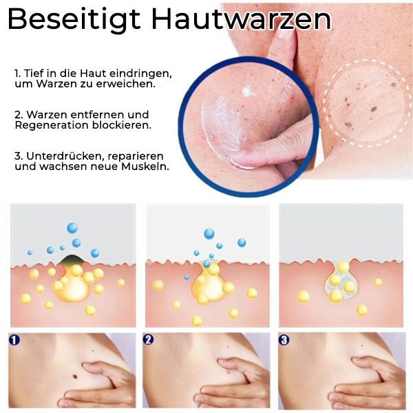 Fivfivgo™ Salbe zur Warzenentfernung