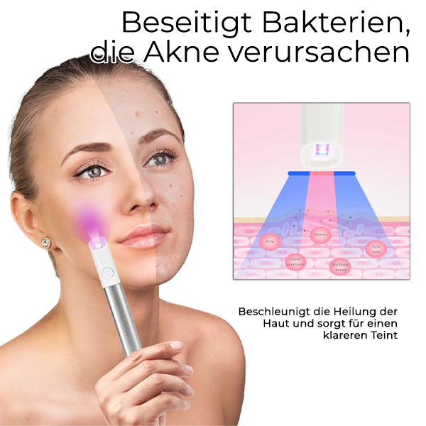 Fivfivgo™ Elektrischer Akne-Löschstift