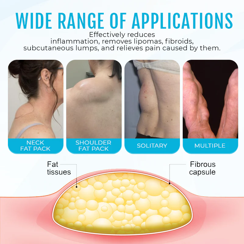 Fivfivgo™ LumpClear Lipom Entlastungscreme