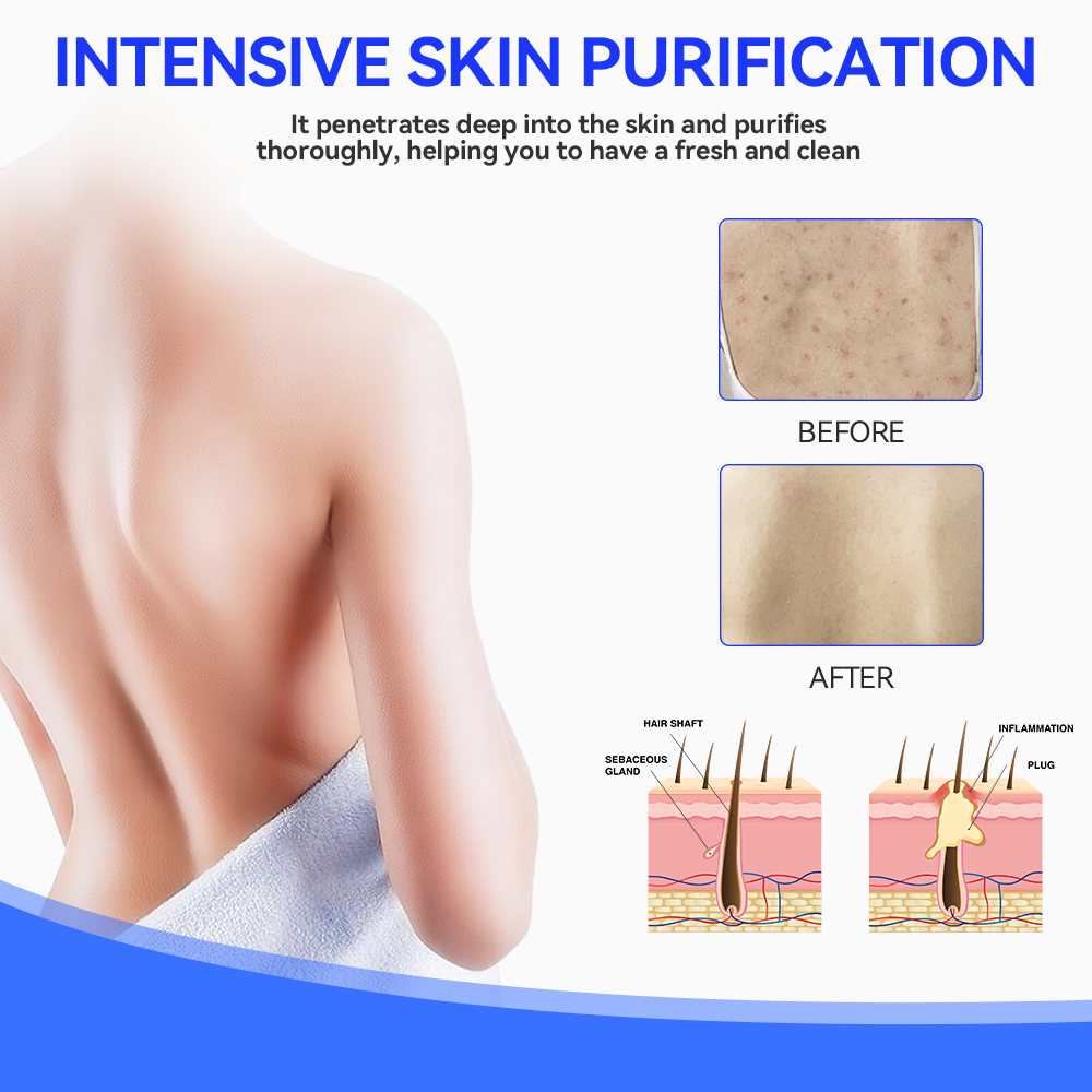 Fivfivgo™ Cheratosi Pilaris & Acne trattamento corpo rinfrescante crema