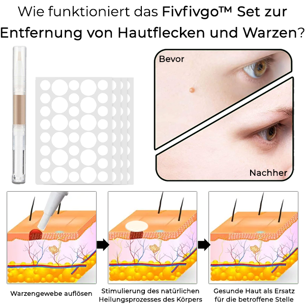 Fivfivgo™ Set zur Entfernung von Hautflecken und Warzen