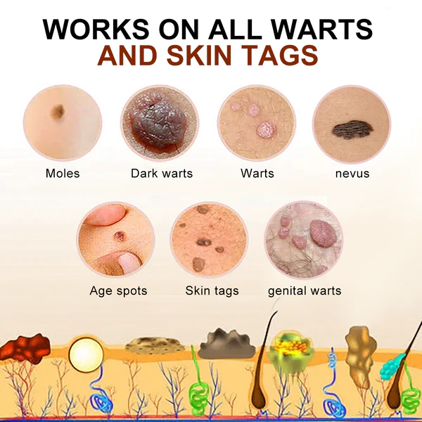 Fivfivgo™ Bee Venom Mole & Wart Treatment Cream