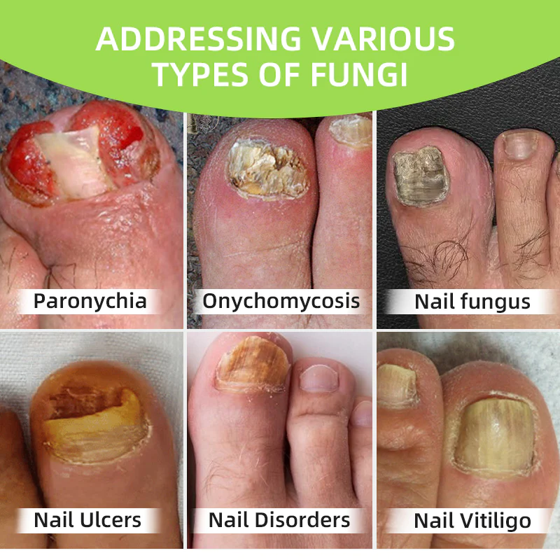Fivfivgo™ Appareil de thérapie laser pour mycoses des ongles Max