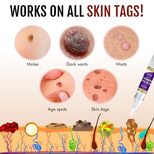 Dissolvant d'étiquettes et de grains de beauté Fivfivgo™