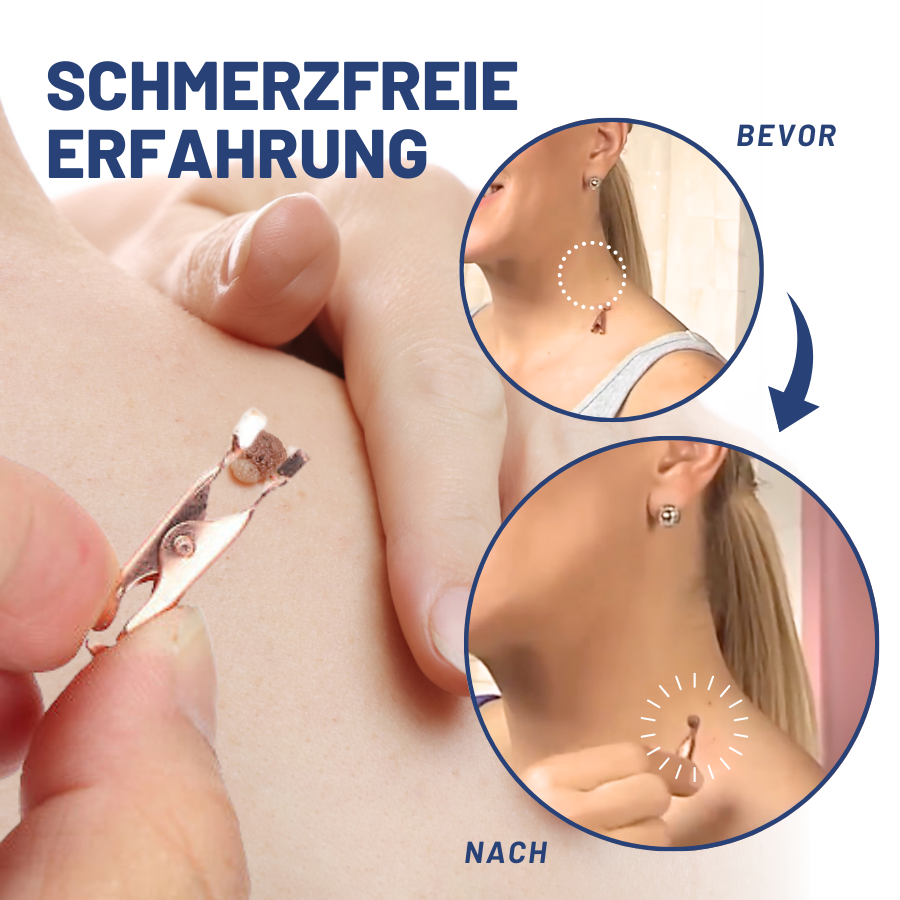 Fivfivgo™ Maulwurfsentfernung Keimfreie Zange