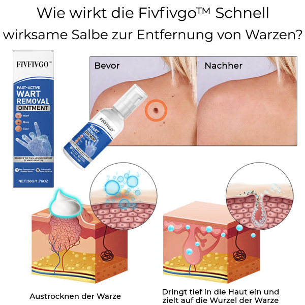 Fivfivgo™ Schnell wirksame Salbe zur Entfernung von Warzen