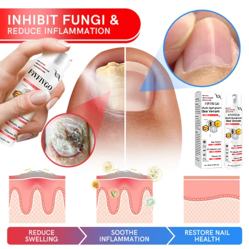 Fivfivgo™ Spray zur Behandlung von Bienengift-Psoriasis mit mehreren Symptomen