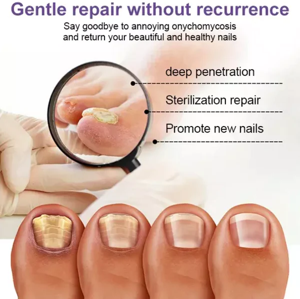 Stylo de traitement de l'onychomycose Fivfivgo™