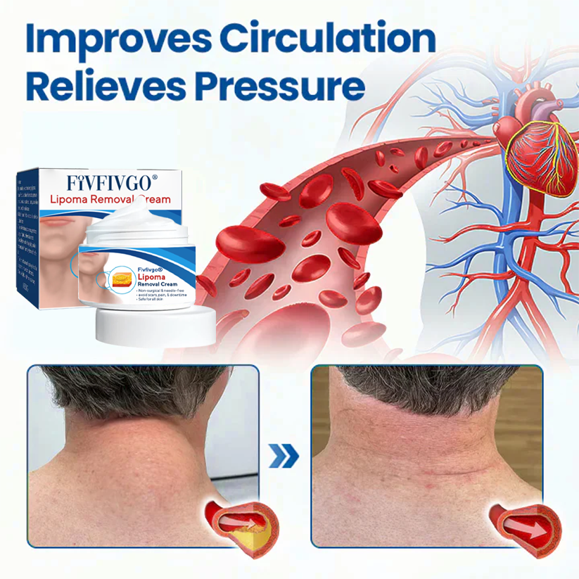 Fivfivgo® Lipoma Removal Cream