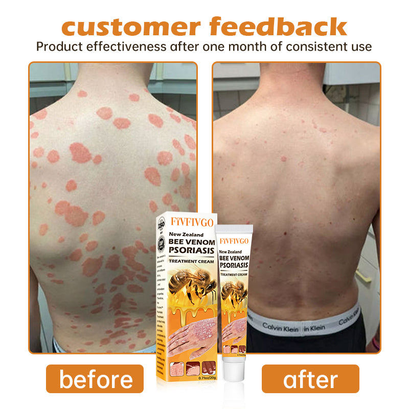 Fivfivgo™ Neuseeland Bienengift Psoriasis Behandlung Creme