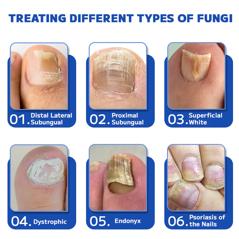 Fivfivgo™ Dispositif Laser de Traitement des Ongles Fongiques