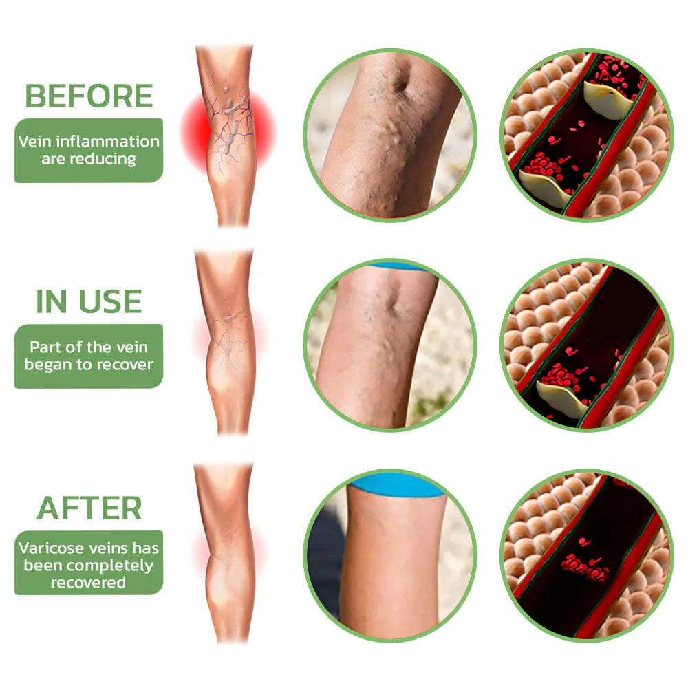Fivfivgo™ Fat Burning Shaping & Varicose Veins Immediate Relief Burst Beads Patch