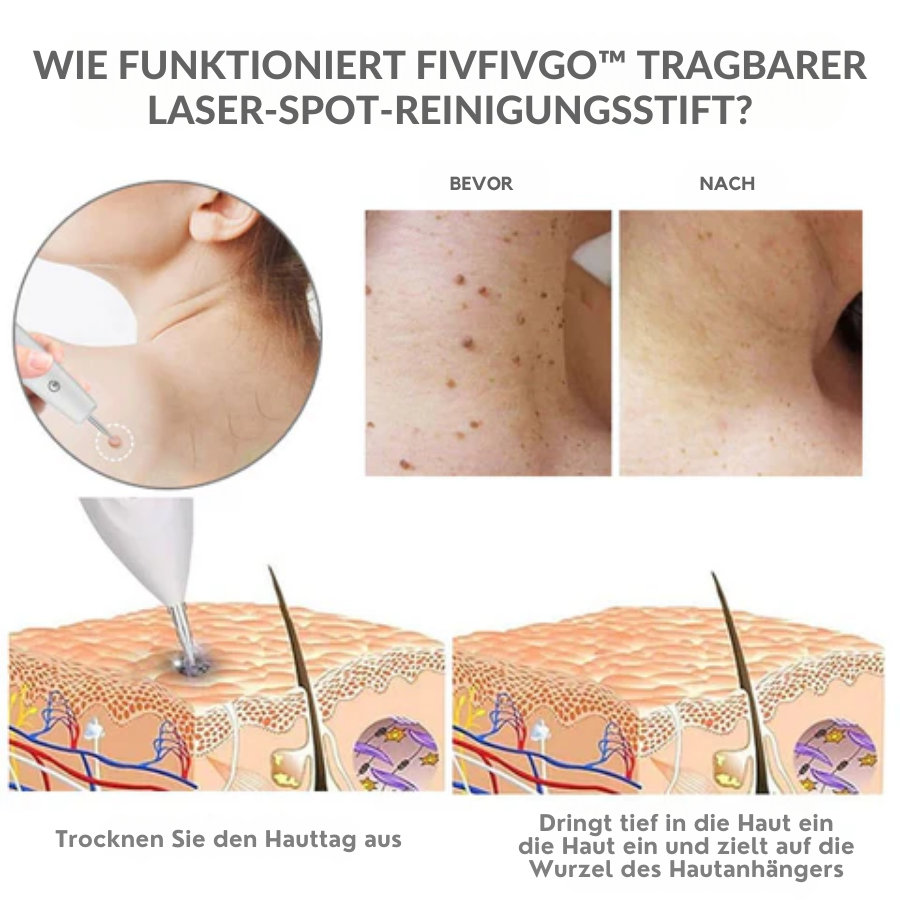 Fivfivgo™ Tragbarer Laser-Spot-Reinigungsstift