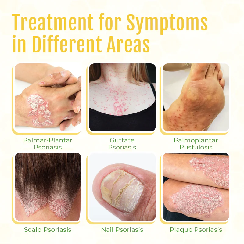 Fivfivgo™ PsorHeal Mehrzweck-Psoriasis-Creme