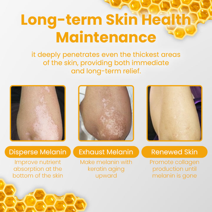 Fivfivgo™ Vitiligo Rescue Bienengift Pflegecreme