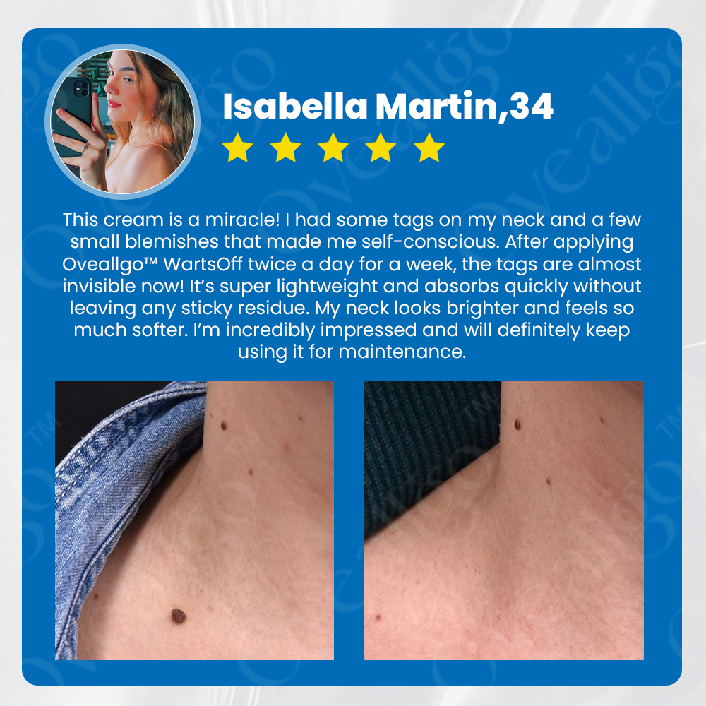 ✅ Official Store: Oveallgo™ WartsOff Instant Blemish Removal Cream👩‍⚕️USA Dermatology Association (AADA）Approved (Skin Tags, Warts, Dark Spots Removal)