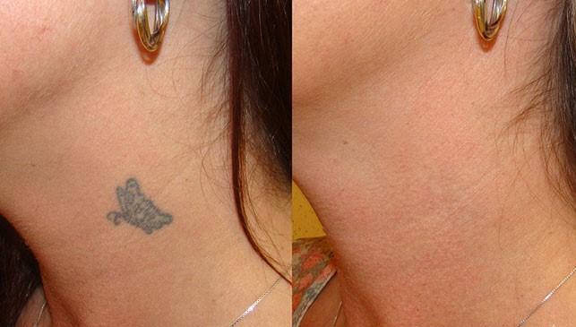 Permanent Tattoo Removal Cream