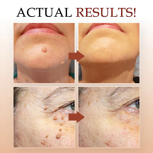Dissolvant d'étiquettes et de grains de beauté Fivfivgo™