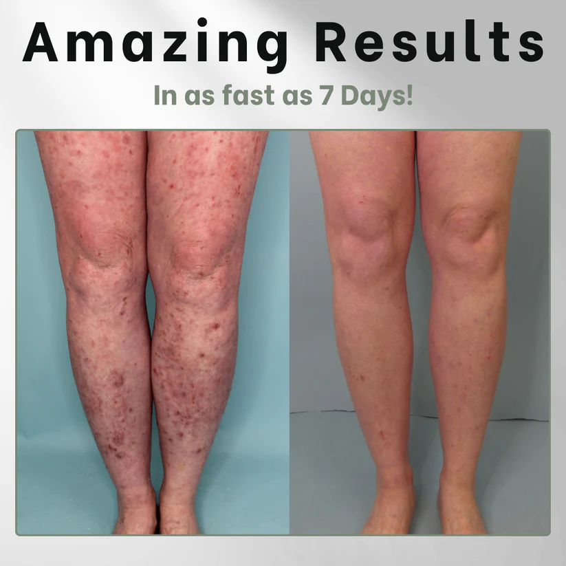 Fivfivgo™ Eczema Herbal Salve