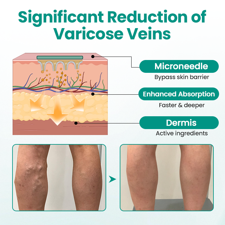 Fivfivgo® LegRenew Varicose Veins Patch