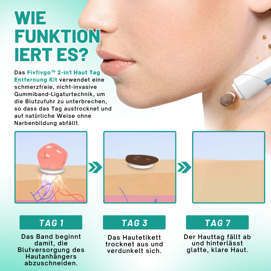 Fivfivgo™ 2-in1 Haut Tag Entfernung Kit