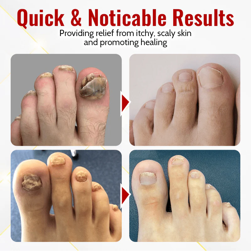 Fivfivgo™ Japanese Nail Renew Onychomycosis Swift Relief Oil