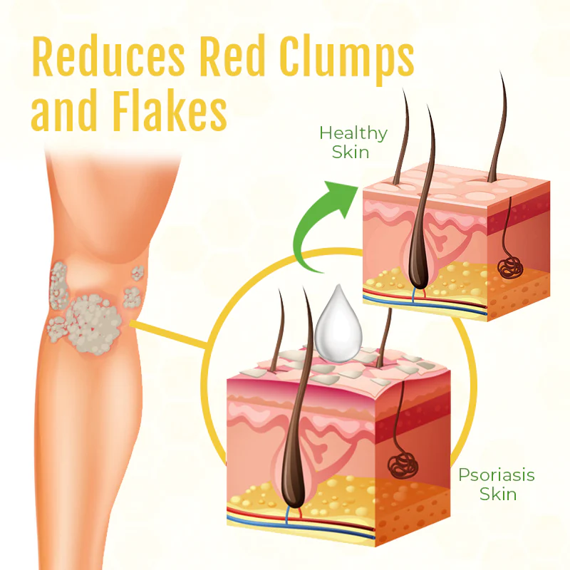 Fivfivgo™ PsorHeal Mehrzweck-Psoriasis-Creme