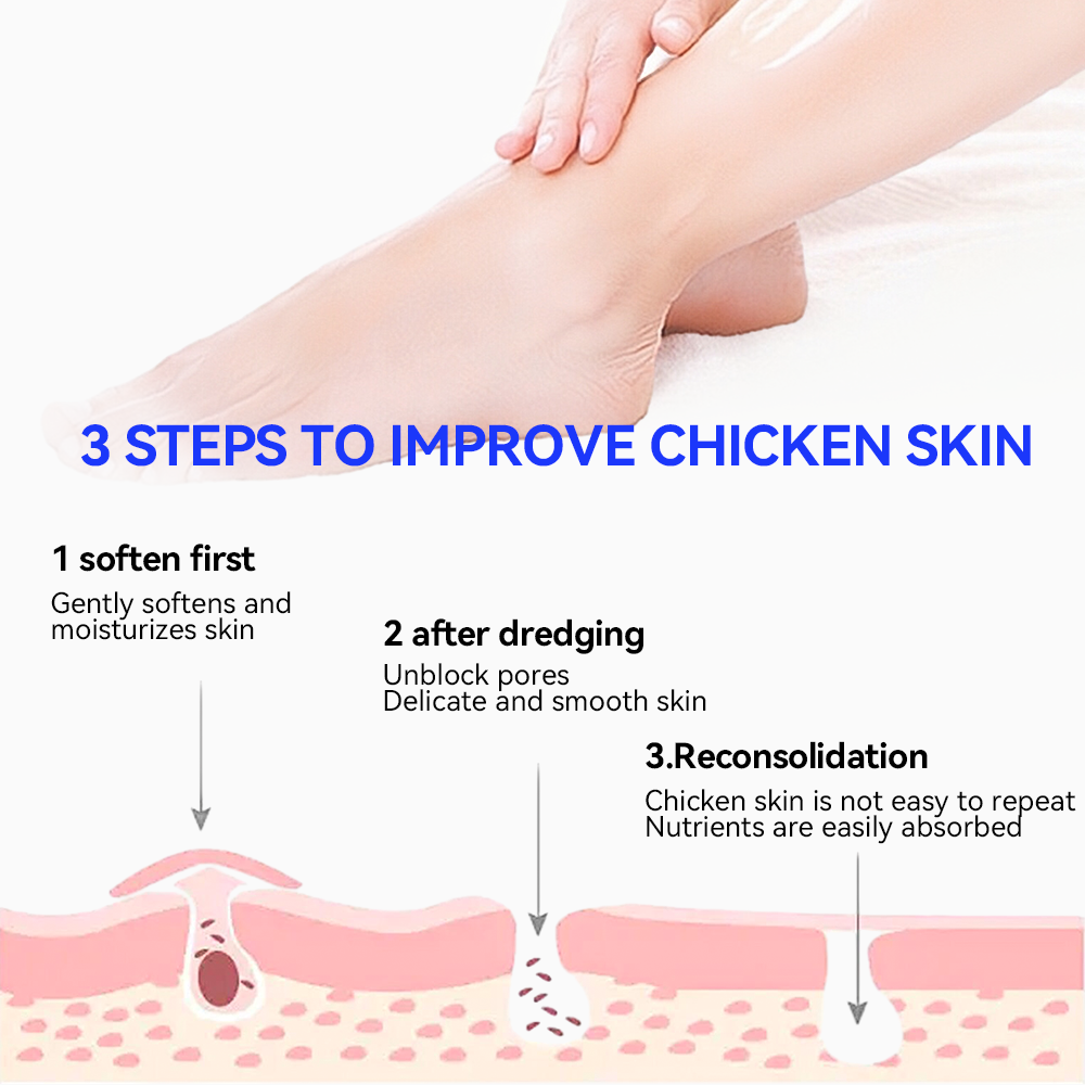 Fivfivgo™ Cheratosi Pilaris & Acne trattamento corpo rinfrescante crema