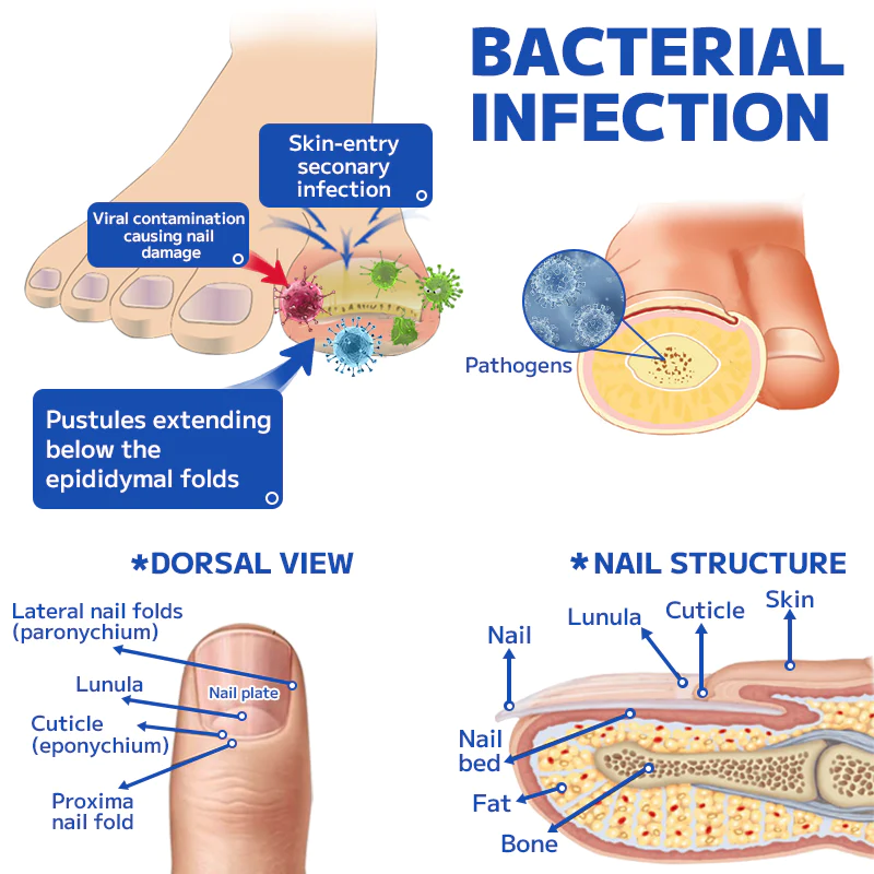 Fivfivgo™ Lasergerät zur Behandlung von Nagelpilz