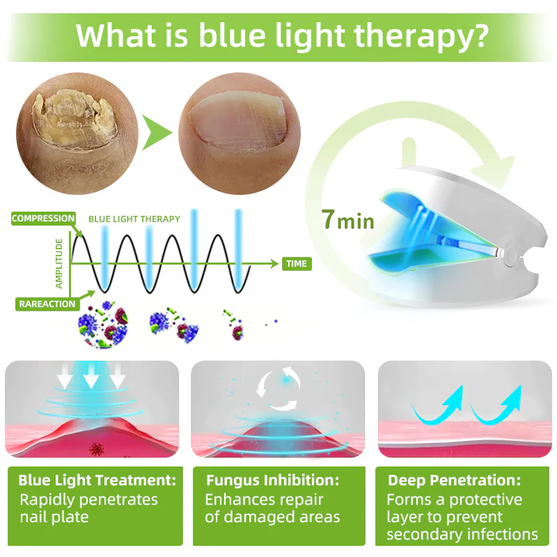 Fivfivgo™ Nagelpilz-Lasertherapiegerät Max