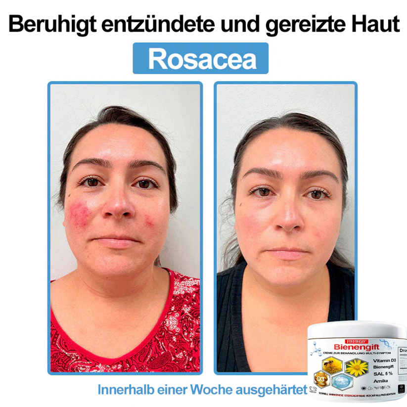 Fivfivgo™ Bienengift Creme Zur Behandlung Multi-symptom