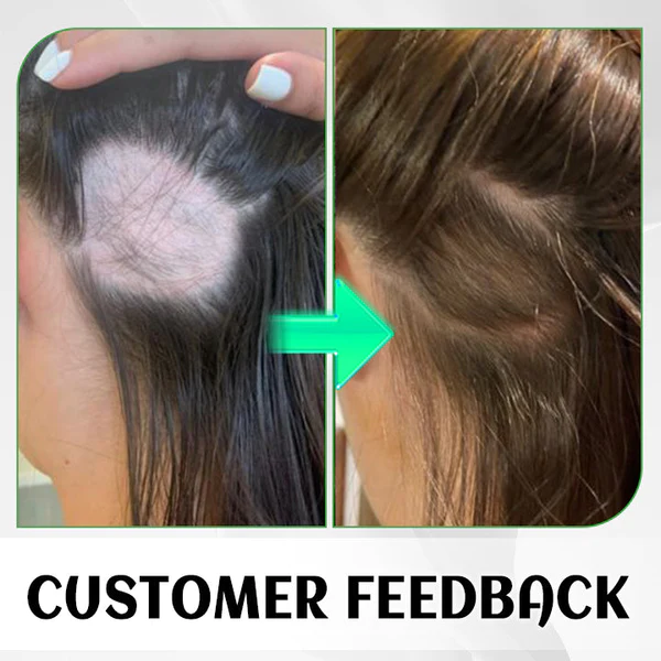 Fivfivgo™ FolliHerb Spray pour la croissance des cheveux