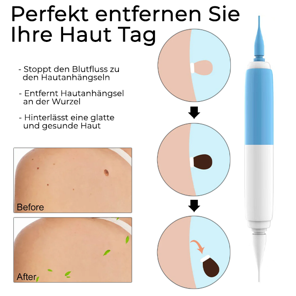 Fivfivgo™ 2-in1 Werkzeug zur schmerzlosen Entfernung von Hautmarkierungen