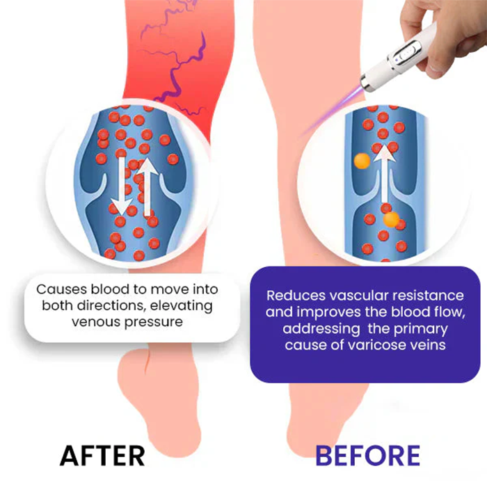 Fivfivgo® Varicose Vein Photothermal Laser Treatment