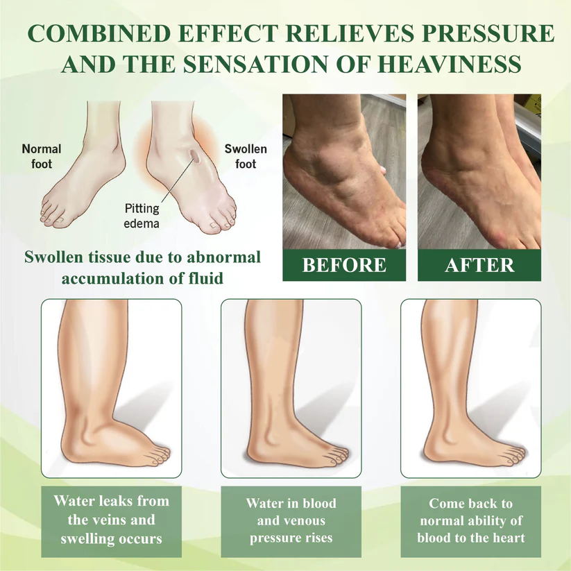 NovaRX® Edema Drain Duo Therapy Roller Cream