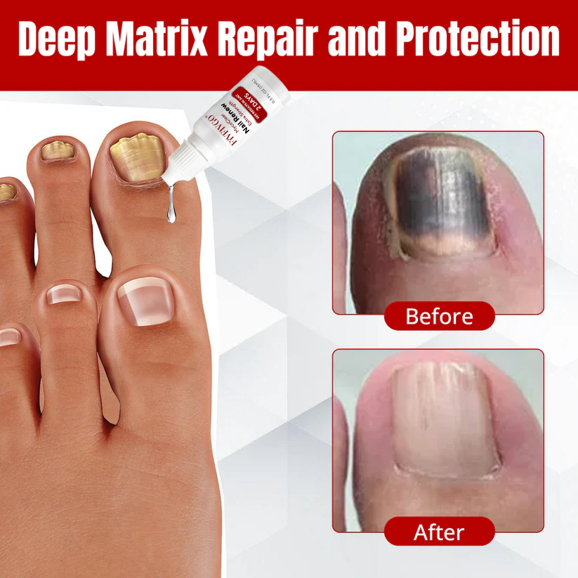 Fivfivgo® MycoClear Nail Renew Extra Strength