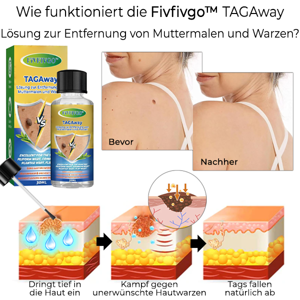 Fivfivgo™ TAGAway Lösung zur Entfernung von Muttermalen und Warzen