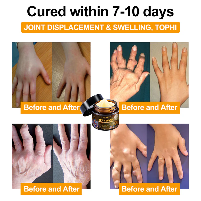 Fivfivgo™ Bee Venom Arthritis Therapy Cream (Specially for older adults & AAOS recommends)