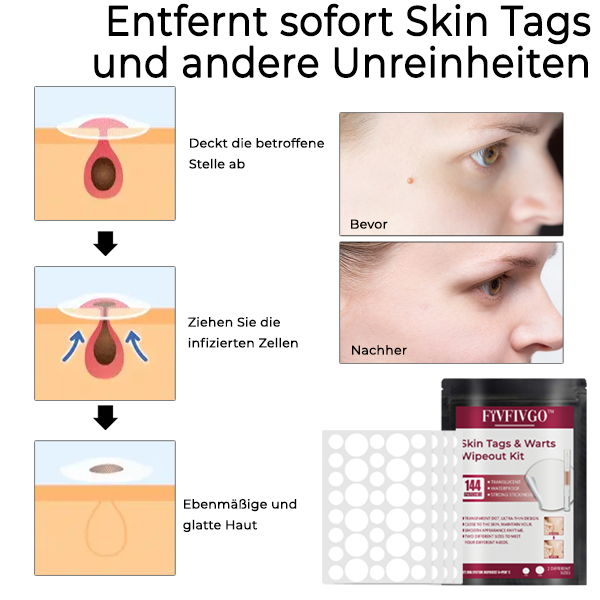 Fivfivgo™ Set zur Entfernung von Hautflecken und Warzen
